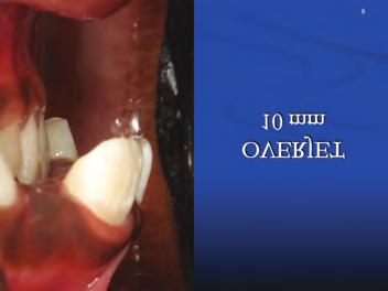 Sagittal or Tandem Appliance to correct the malocclusion in the mixed dentition in 7-9 months, non-surgically.