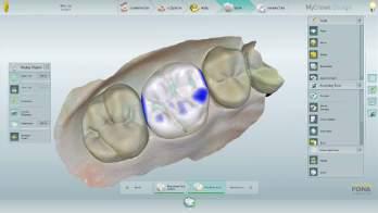 FEATURES AND OPTIONS RANGE OF INDICATIONS The integrated chairside MyCrown CAD/CAM system is ready to create veneers, inlays, onlays, crowns and bridges covering up to 3 teeth in one