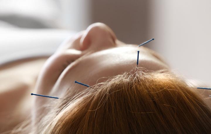 Acupuncture Headache Relief Discovered Published by HealthCMi on November 2017 Acupuncture enhances positive patient outcome rates for patients suffering from headaches.