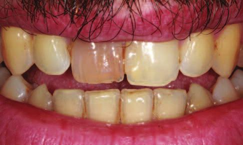 Discolouration had been present for more than 10 years, and previous treatment had included fibre post placement.