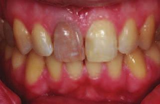 We could improve the symmetry of anterior guidance with the veneers, benefitting function.
