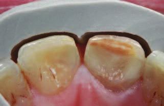It is much easier and more predicable to perform two symmetrical porcelain veneers than a single, asymmetrical one 3.