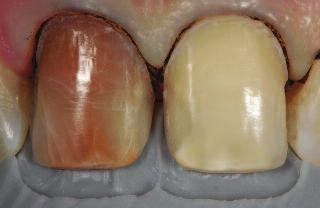 After rubber dam isolation, the porcelain veneers were cemented simultaneously with the composite resin cement (D Arcangelo et al, 2012) (Figures 15-18).