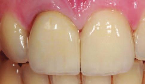 In cases where the internal bleaching technique compromises the remaining tooth structure, other options (such as porcelain or composite veneers) should