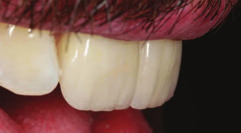 J Endod 16(12): 570-574 Magne P, Belser U (2002) Bonded Porcelain Restorations in the Anterior Dentition: A Biomimetic Approach.