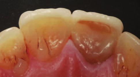 J South Calif Dent Assoc 31: 289-291 Plotino G, Buono L, Grande NM, Pameijer CH, Somma F (2008) Nonvital tooth bleaching: a review of the literature and clinical procedures.