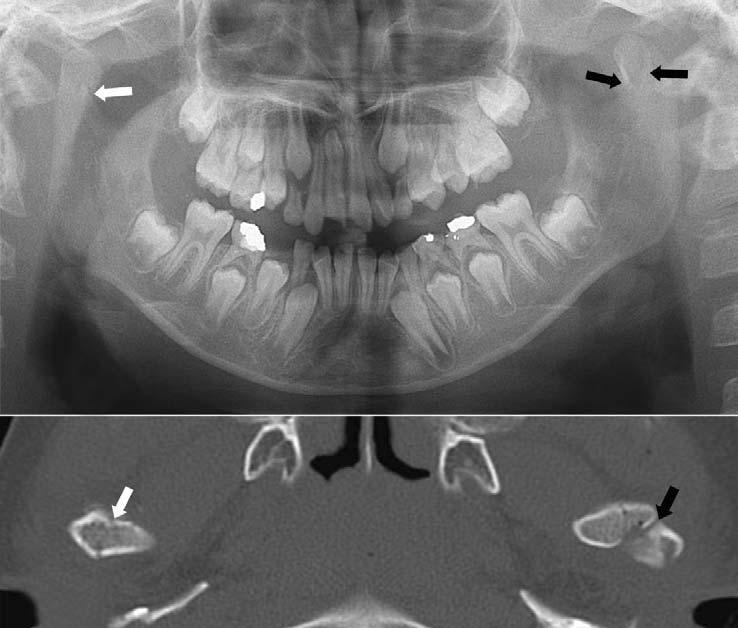 Bong-Hae Cho Fig. 1. Panoramic (A) and cone beam CT (B) images show sagittal splitting (white arrow) and condylar neck (black arrow) fracture. A B Fig. 2.