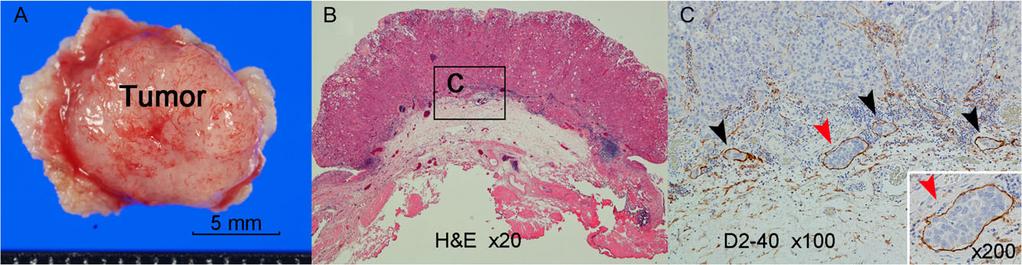 448 LVI in HG pt1 UCB prognosis (3 6).