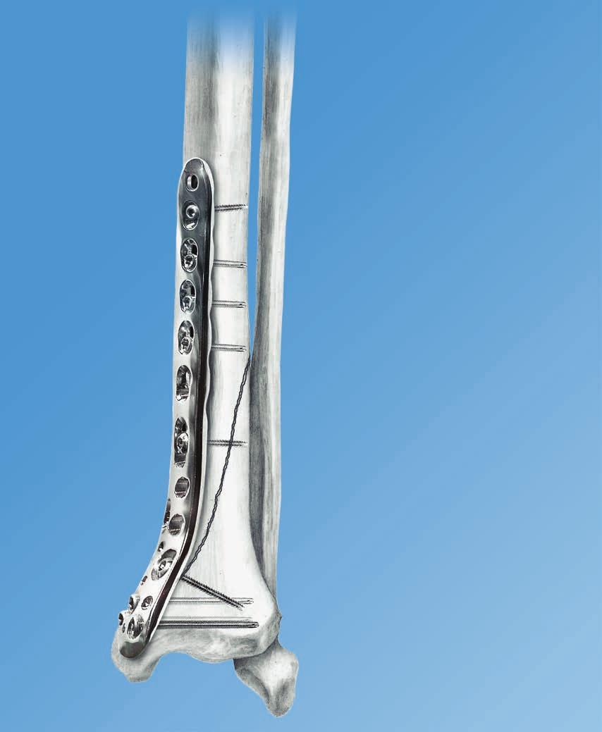 LCP Medial Distal Tibia Plate,