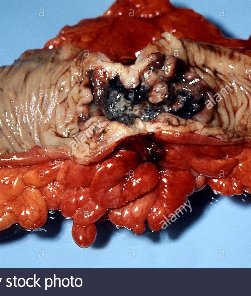 Malignant tumours invade surrounding tissue This pic shows a malignant