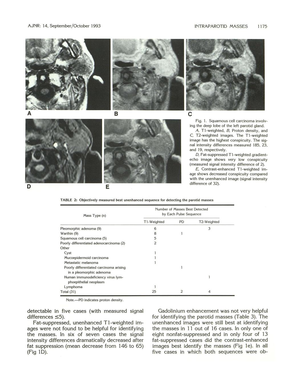 AJNR:, September/October 99 INTRAPAROTID MASSES 7 A 8 D E c Fig.. Squamous cell carcinoma involving the deep lobe of the left parotid gland. A, T-weighted, B, Proton density, and C, T-weighted images.
