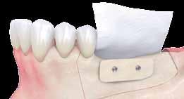 By adapting the width of the plate, the crestal dimensions can be adjusted to finally fit the desired type of implant.
