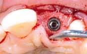 Filling dehiscence gap with Socketol or if too shallow with Solcoceryl may be beneficial.