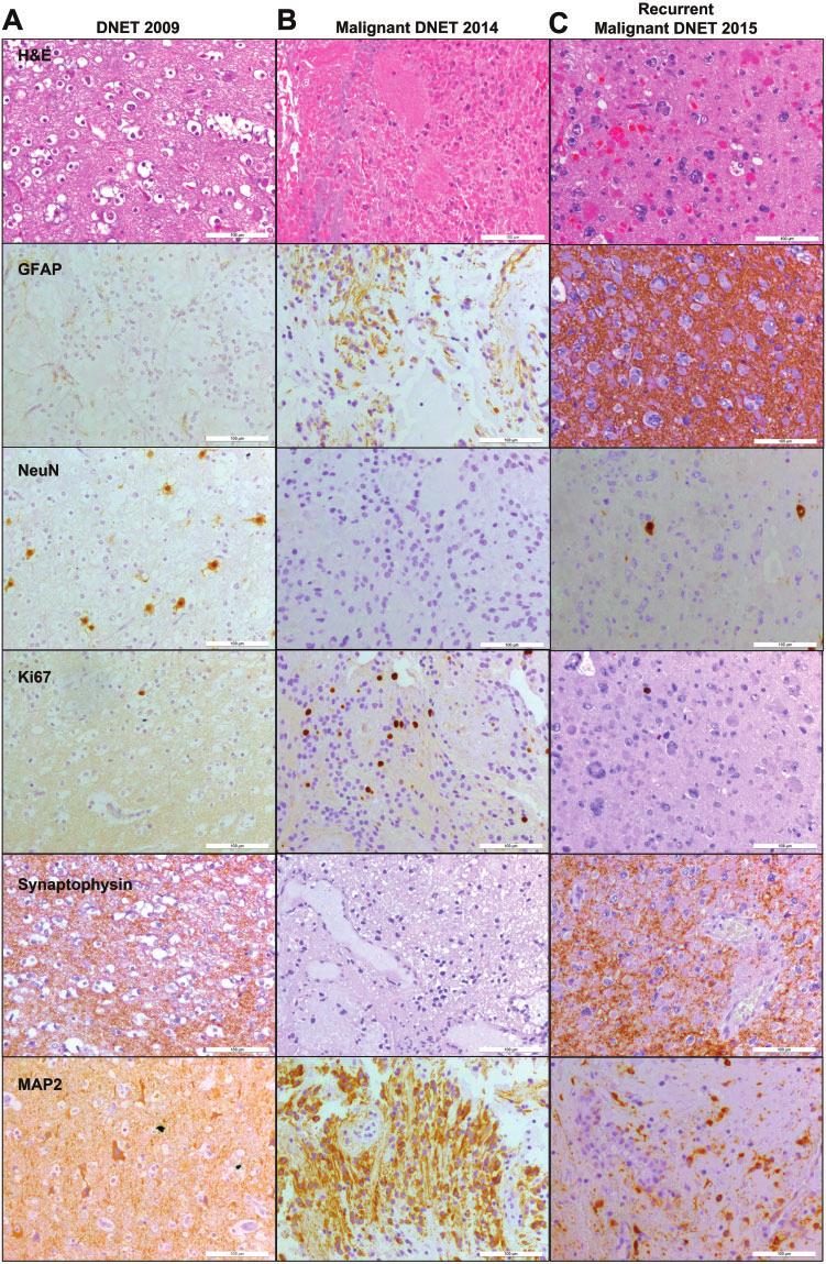 Heiland et al J Neuropathol Exp Neurol Volume 75, Number 4, April 2016 FIGURE 2. Histopathology and immunostaining of samples in 2009, 2014, and 2015.