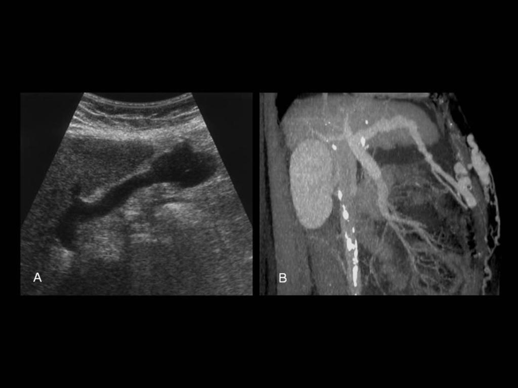 Fig.: PARAUMBILICAL VENOUS COLLATERALS (A - B) US longitudinal scan A) and sagittal MR portal venography B) show the paraumbilical vein coursing from the left portal vein through the falciform