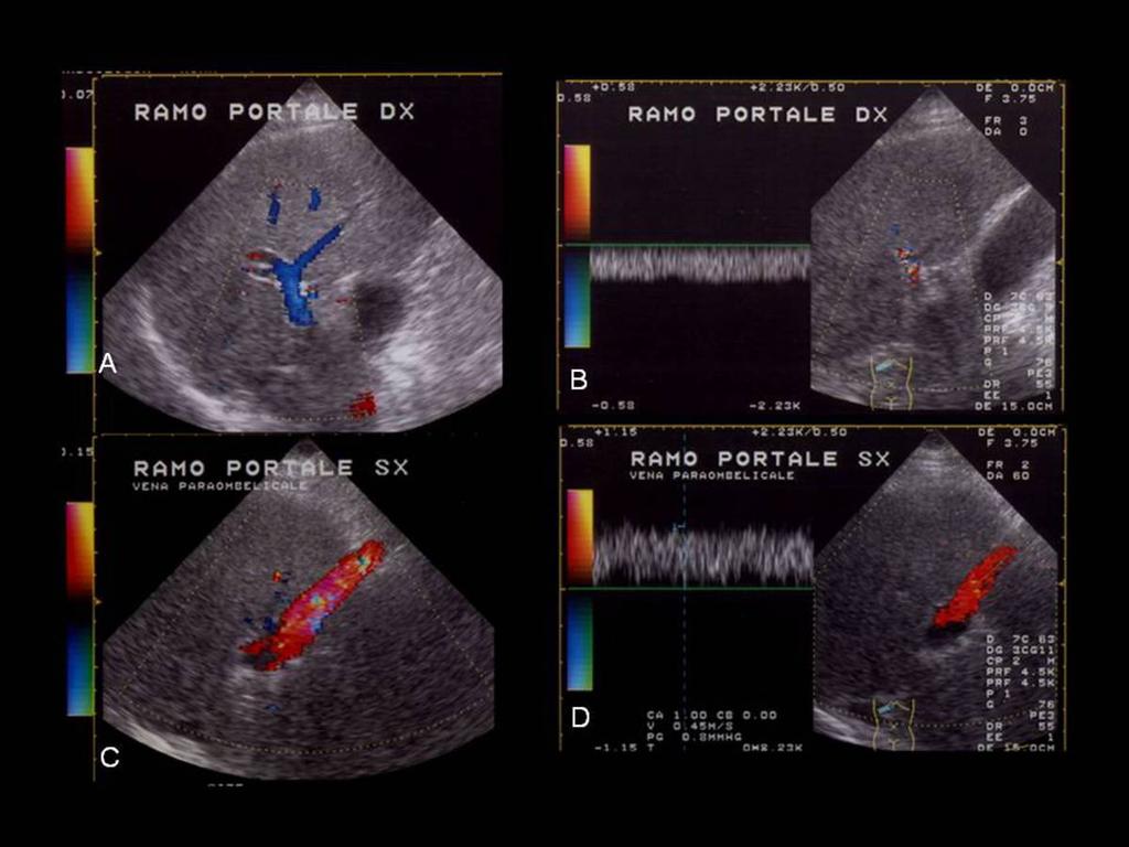 Fig.: PARAUMBILICAL VENOUS COLLATERALS (A - B - C - D) Color Doppler is essential in the evaluation of hemodynamic chages related to a large paraumbilical shunt.