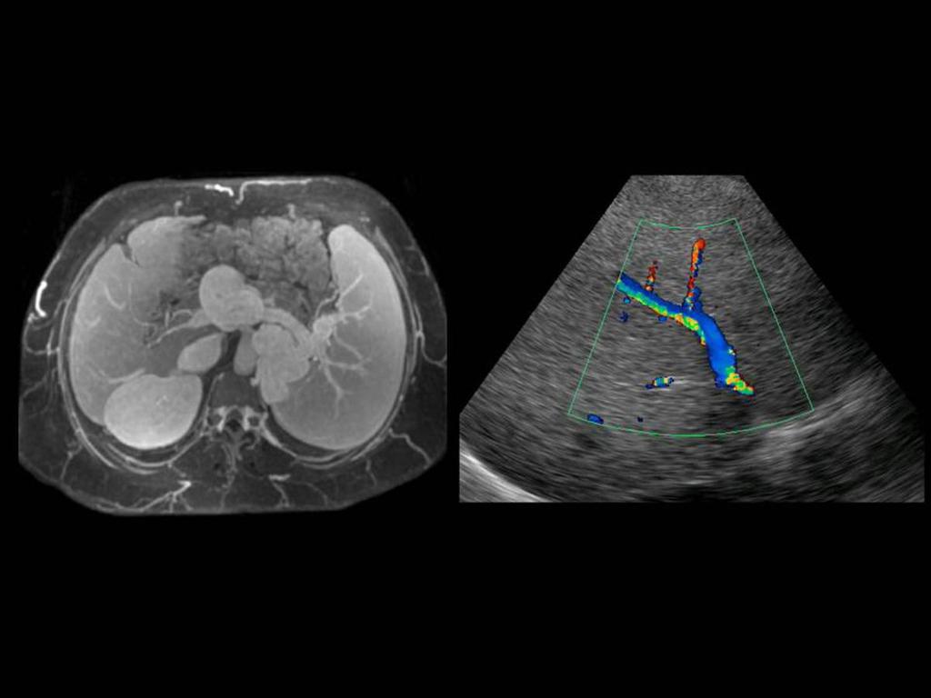 Fig.: SPLENORENAL VENOUS COLLATERALS (A - B) In cases of large splenorenal shunts portal flow is diverted through the left renal vein to the inferior vena cava.
