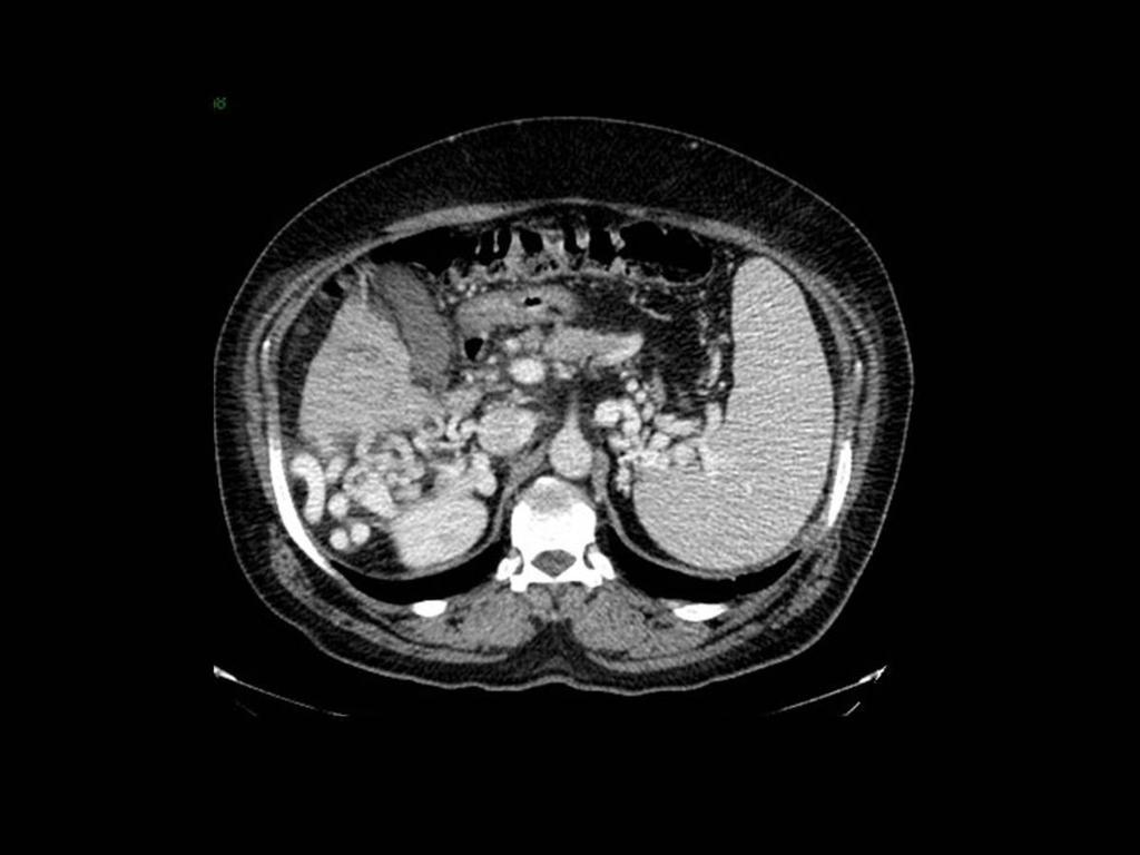 Fig.: RETROPEROTONEAL COLLATERALS CT scan shows retroperitoneal collateral vessels in the right perirenal fat.