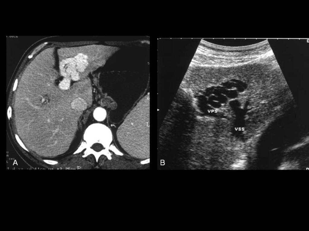 Fig.: INTRAHEPATIC VENOUS COLLATERALS CT scan A) and US B) show intrahepatic collateral vessels as