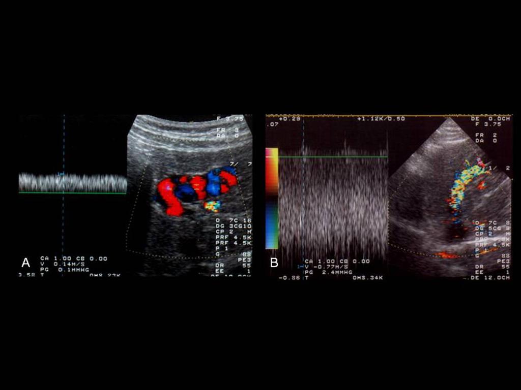 Fig.: INTRAHEPATIC VENOUS COLLATERALS Color Doppler shows continuous flow in the intrahepatic collateral vessels
