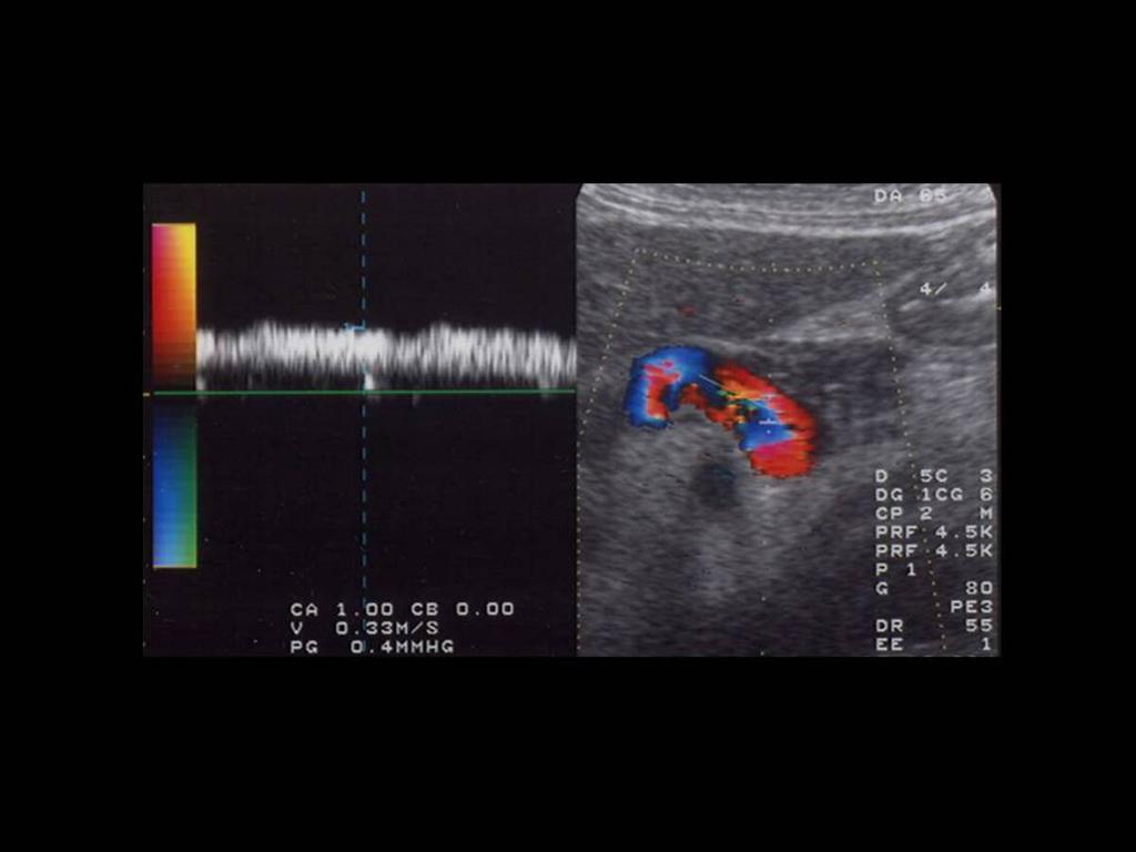 Fig.: CORONARY VEIN Color Doppler shows an enlarged coronary vein with high velocity (VM 0.