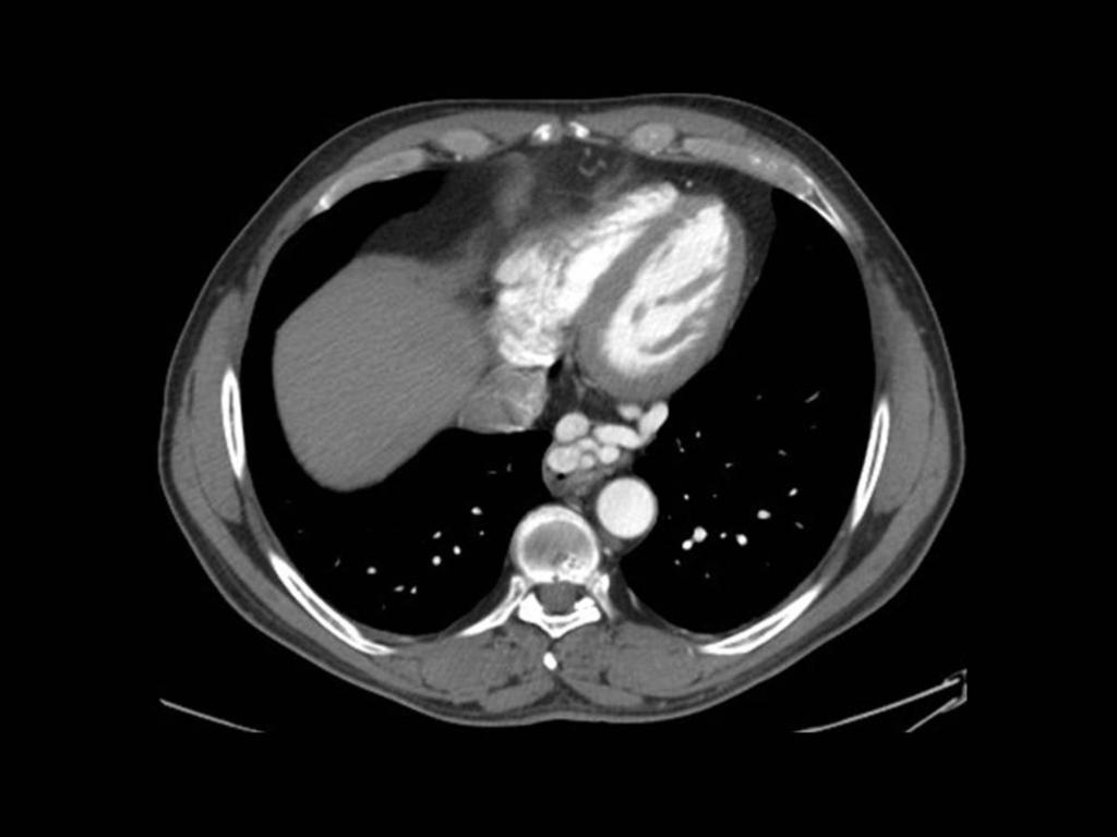 Fig.: ESOPHAGEAL VARICES CT shows dilated veins in the wall of the lower esophagus