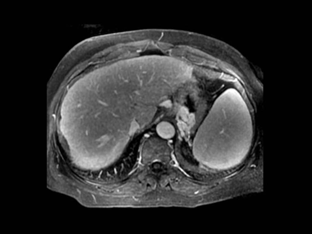 Fig.: GASTRIC VARICES MR shows dilated veins in the wall of the gastric fundus Dilated short gastric veins that communicate with the splenic vein can be seen at the splenic hilum, along the