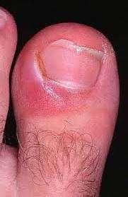 Signs, Symptoms of Infection Localized infections Redness, pain, warmth,