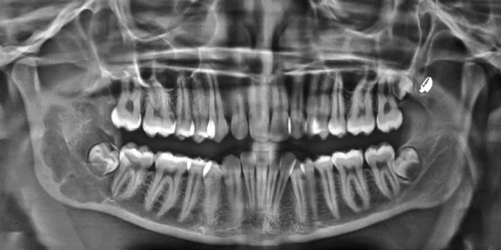 Glandular odontogenic cyst: A case report Case Report A 17-year-old female patient was referred to the Outpatient Department of Oral Medicine and Radiology at Nair Hospital Dental College, Mumbai, by