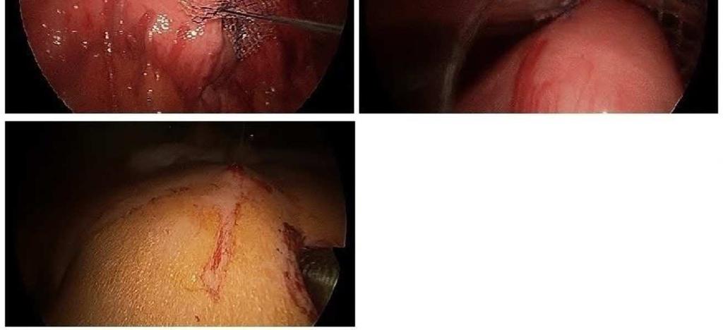 hernia sac, gastropexy and utilisation of vypro
