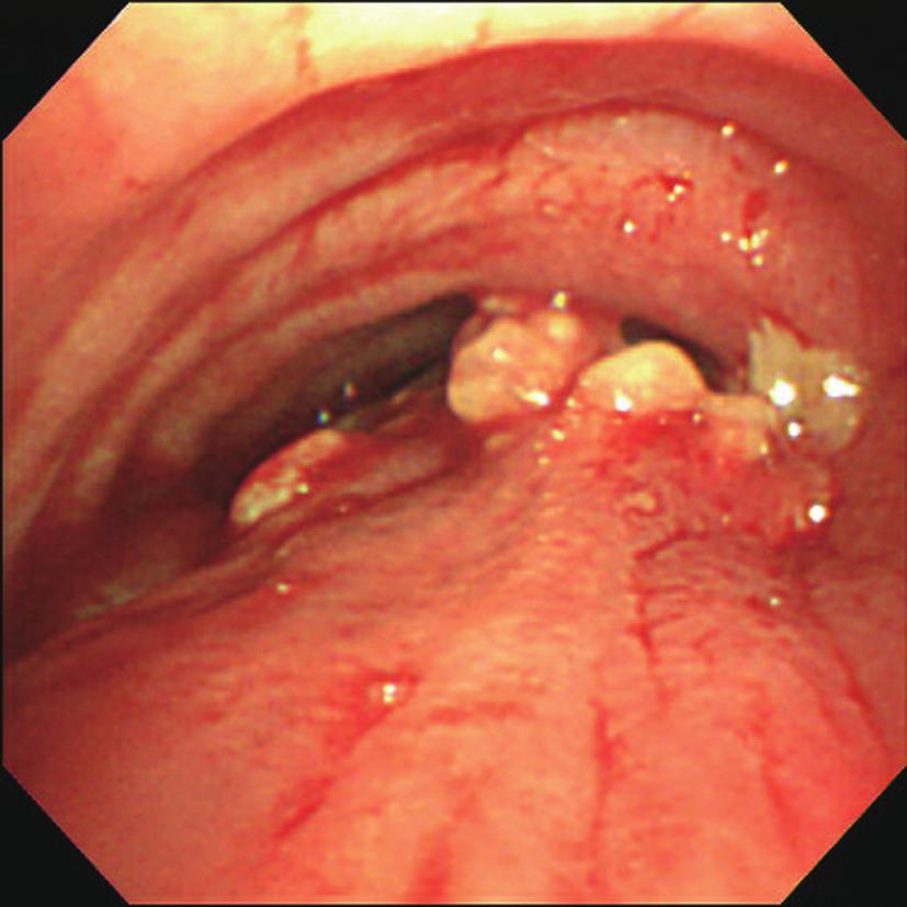 Ying-Jen Chang et al. Fig. 3. Bronchoscopy showed airway narrowing and protruding tissue from posterior wall of the trachea. Fig. 4.