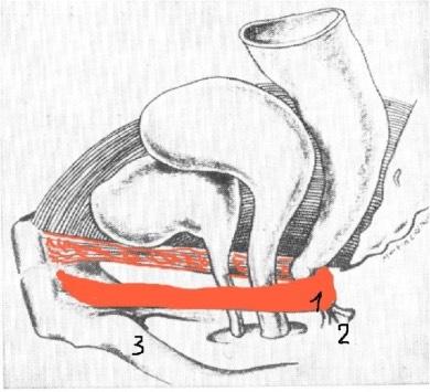 (anorectal angle is more than 140 degrees) we use prosthetics of puborectal musle with the creation of anorectal angle Produce two