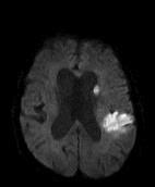 WP 02- motion artifacts Left-sided, MCA-territory ischemic stroke including the basal ganglia Although there are considerable motion artifacts in the area of the lesions, these are clearly visible on