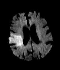 WP 02- leukaraiosis Right-sided MCA-territory ischemic stroke Although