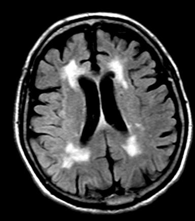 WP 02- negative / positive Right-sided MCA-territory ischemic stroke With enough contrasting the insular ribbon becomes subtly visible in the.