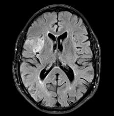 WP 02- negative / positive Right-sided MCA-territory ischemic stroke Even with very mild