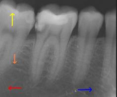 OpenStax-CNX module: m66077 8 Figure 7: X-ray 23 image of teeth in the lower right quadrant.