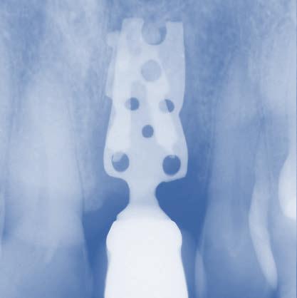 Implant Therapy: Then and Now by Timothy F. Kosinski, DDS, MAGD Implant dentistry has come a long way since blade and subperiostal implants were widely used.