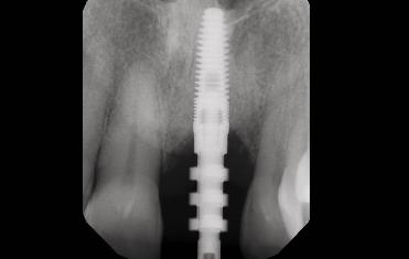 Implant Therapy: Then and Now Figure 5: A bioresorbable barrier was positioned so