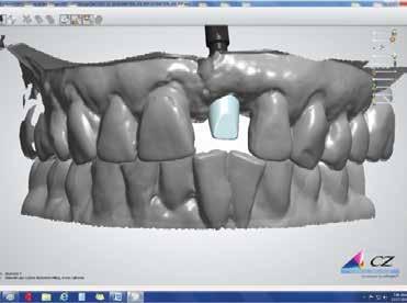 Figure 13: An all-zirconia abutment was created with