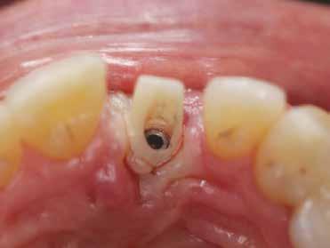 final implant-retained crown.