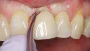 Zirconia abutments for single-tooth implants rationale and clinical guidelines. J Oral Maxillofac Surg.