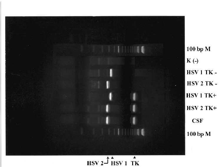 Picture of photographed gel: Legend: 100 bp M: product length marker; 100 basepairs K (-): negative control HSV 1 TK-, HSV 2 TK-: standard viral strains with altered TK gene, resistant to acyclovir