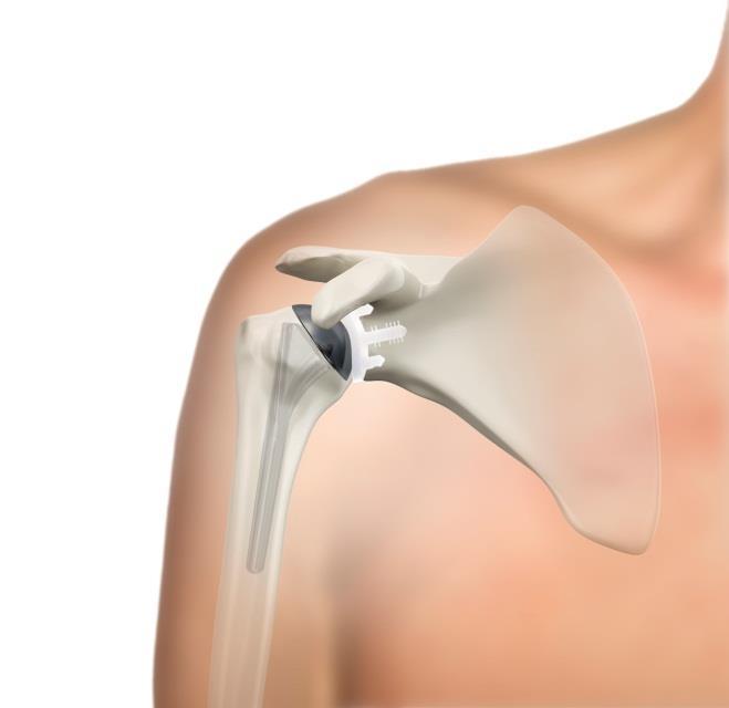 rubbing causes pain, stiffness and swelling. Most patients who decide to have shoulder replacement surgery have experienced shoulder pain for a long time.