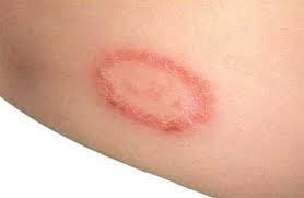 DRUGS FOR CUTANEOUS MYCOTIC INFECTIONS Mold-like fungi that cause cutaneous infections are called dermatophytes or tinea.