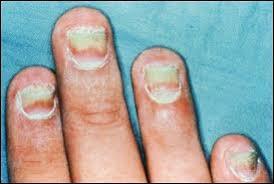 1. Terbinafine Oral terbinafine is the drug of choice for treating dermatophyte onychomycoses (fungal infections of nails).