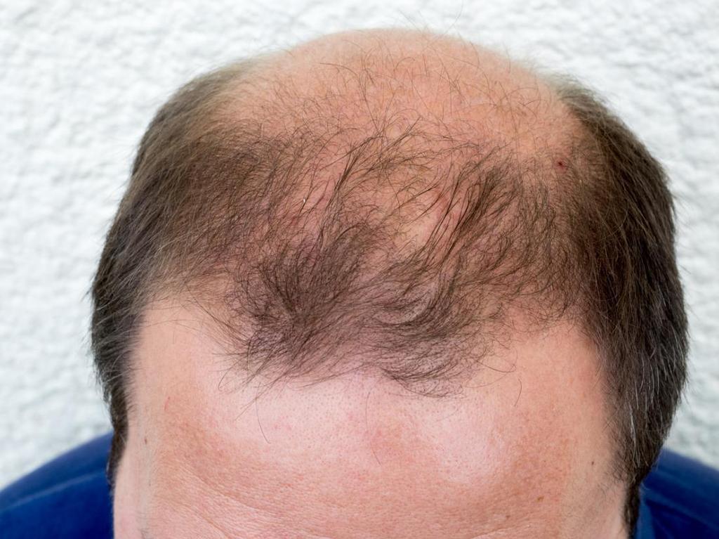 TRICHOGENIC AGENTS Minoxidil and finasteride are trichogenic agents that are
