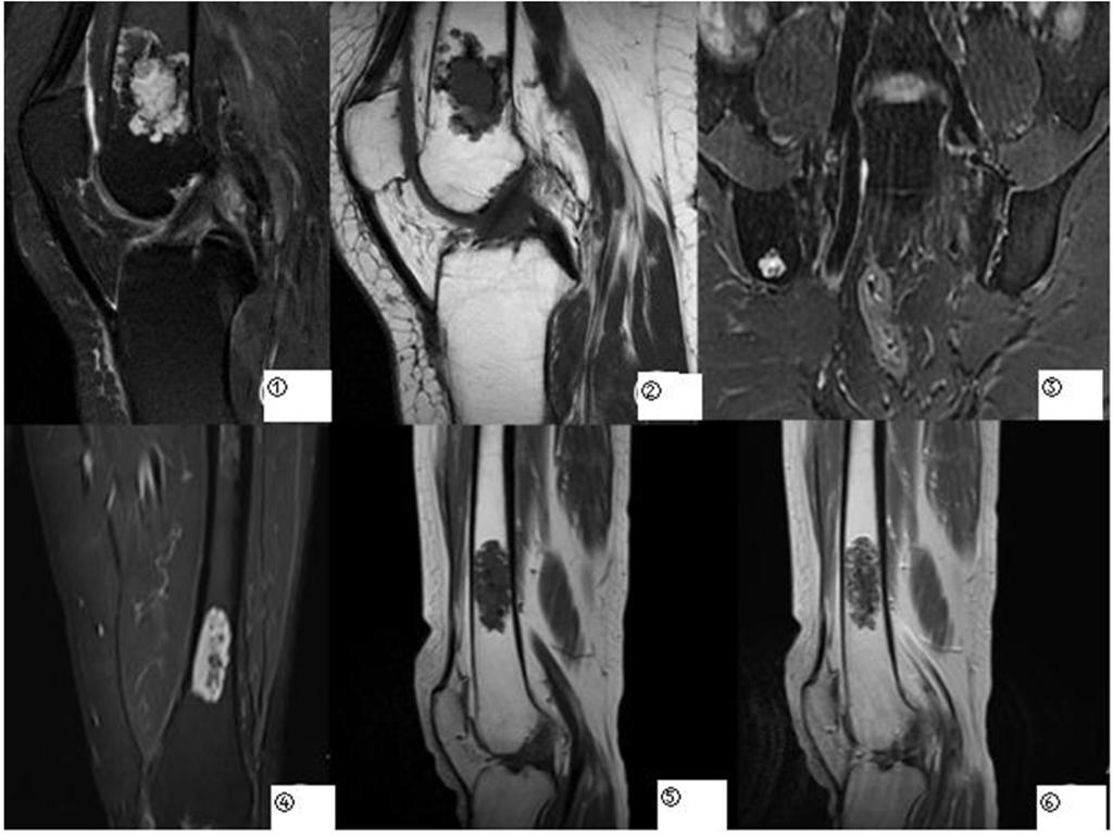 240 CT 3 MRI 4 5 9 10 4 X 2 Fig.2 MRI MRI of atypical cartilaginous tumors 1 2 3 T2 T1 T2 3 4 5 1. chondrosarcoma in the fibula J. Skelet Radiol 2004 33 J.