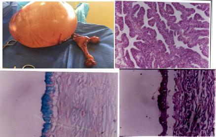 germ cell neoplasm and in some series the most common ovarian neoplasm removed at surgery (7, 8). It is most common ovarian mass in children (9).