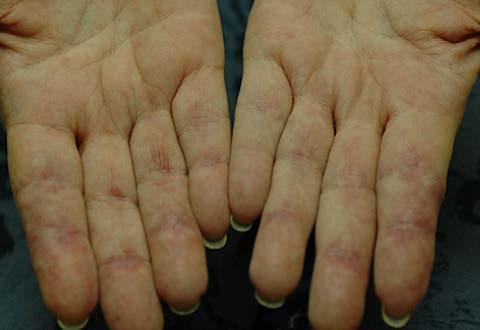 cutaneous ulcerations severe